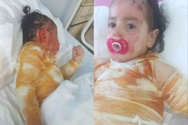 Üç yaşlı Xədicə qaynar suda yanıb: “Bint almağa belə, imkanımız yoxdur” - FOTO